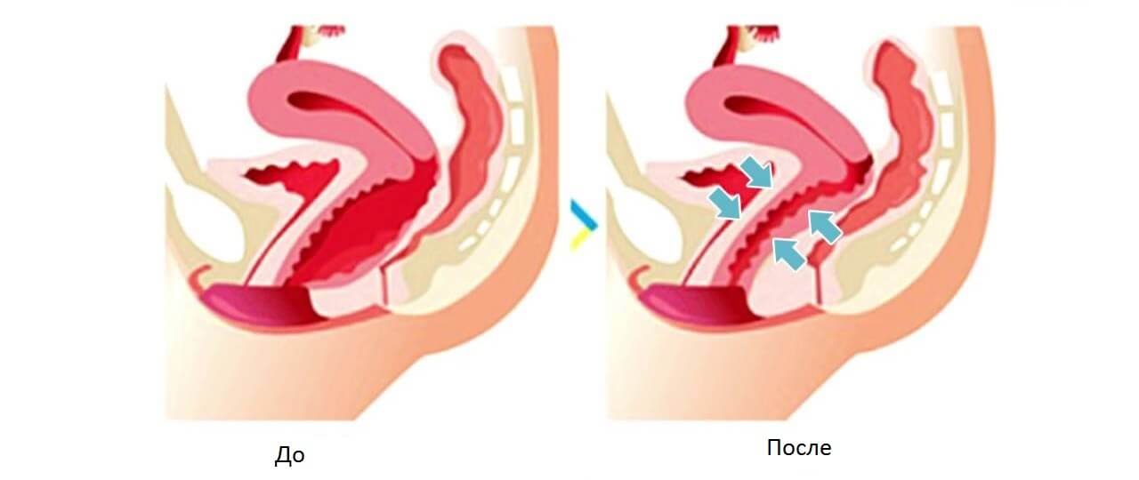 Схема проведения вагинопластики