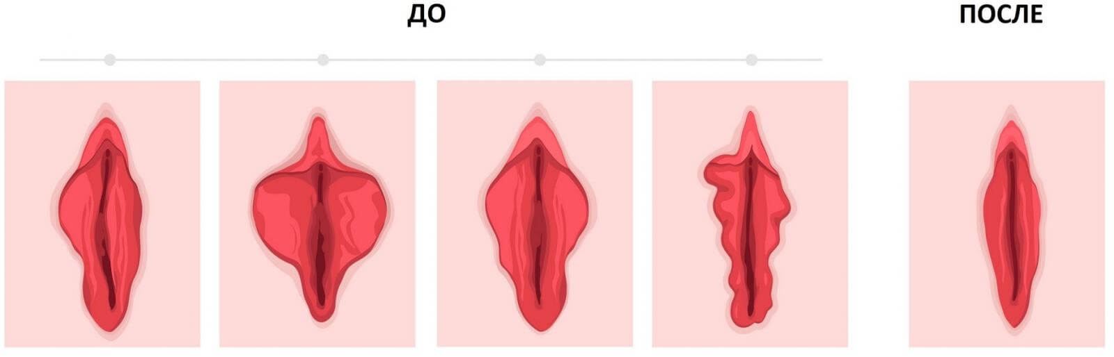 Схема проведения лабиопластики