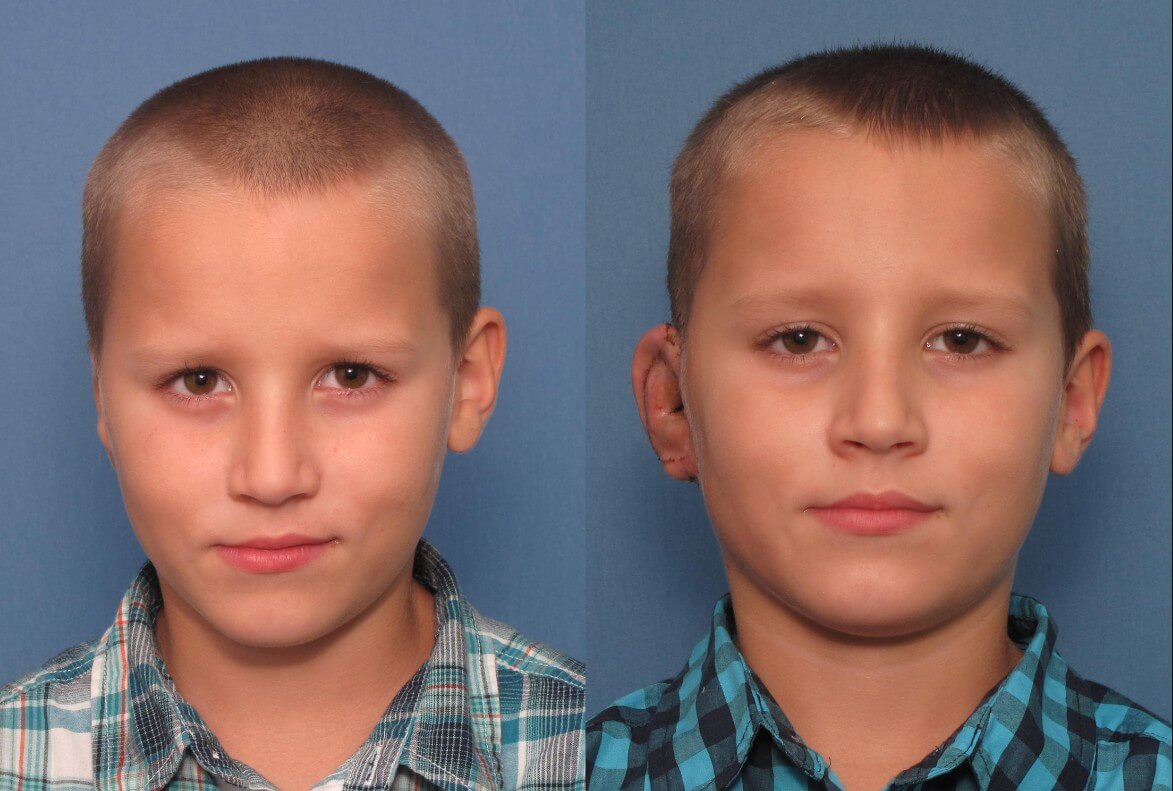 Односторонняя пластика уха при микротии ушной раковины – до и после операции