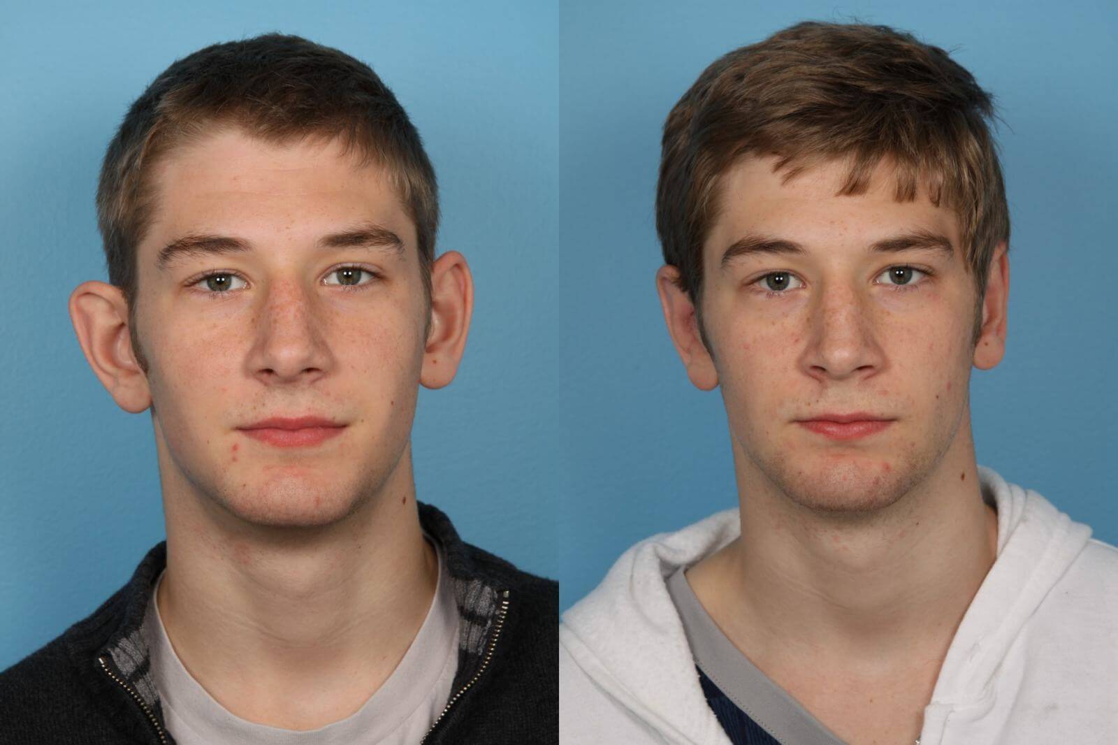 Асимметрия ушей может быть показанием как к односторонней, так и к классической двухсторонней отопластике