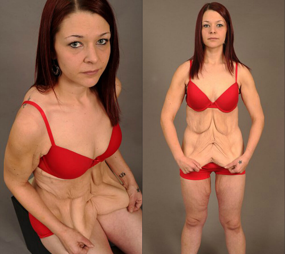 Похудение с&nbsp;большого веса &ndash; это всегда проблемы с&nbsp;дряблой кожей