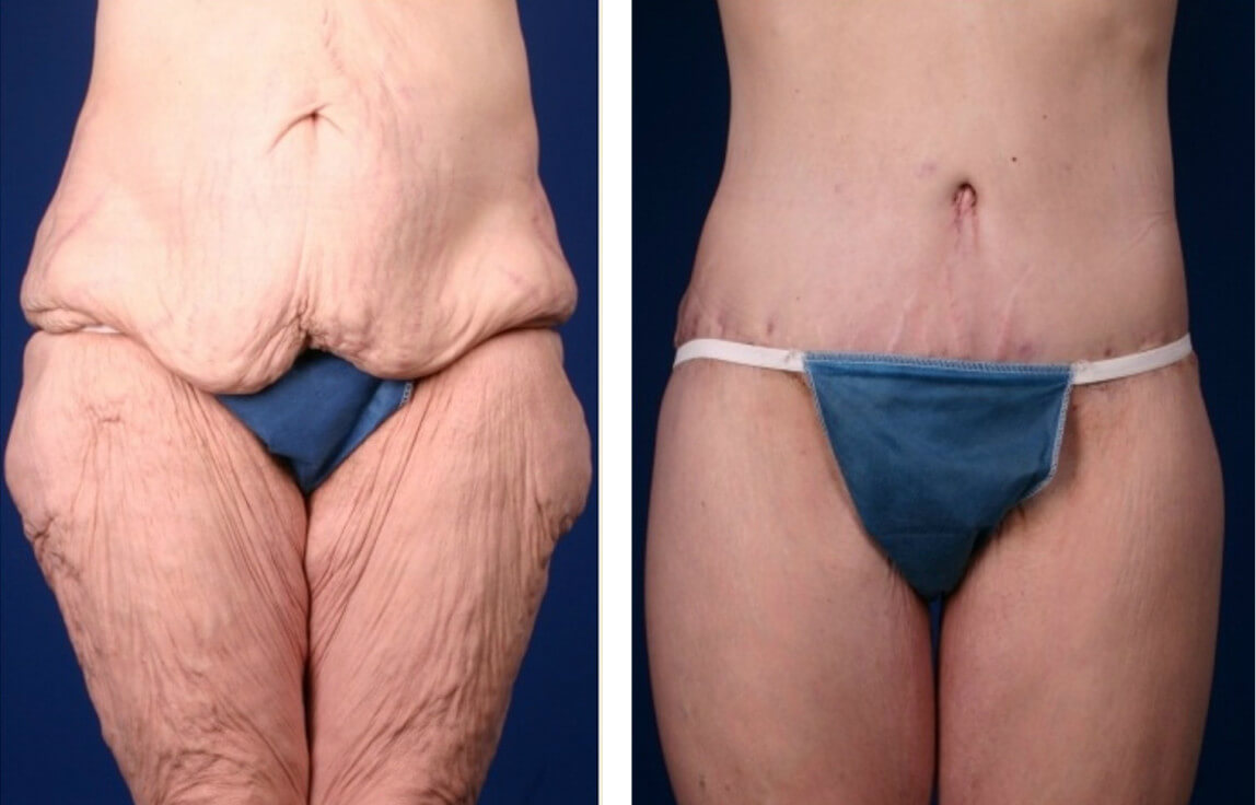 Комплексный подход к&nbsp;пластике после похудения &ndash; залог хорошего результата