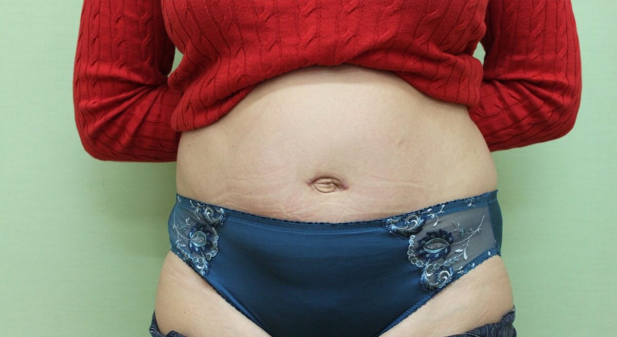 Некрасивый пупок – причина для комплексов и недовольства собой