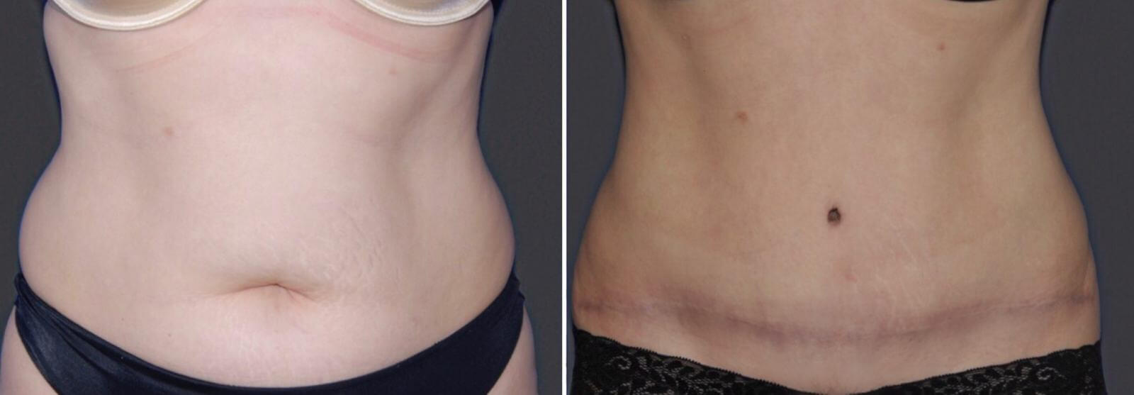 Пластика живота и умбиликопластика – операции, которые отлично сочетаются друг с другом