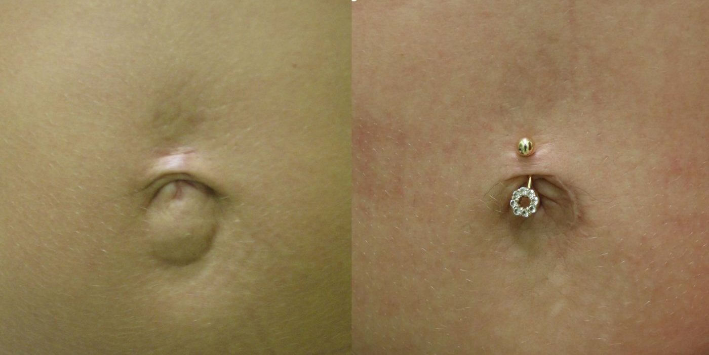 Спустя несколько месяцев после умбиликопластики никаких следов операции уже не видно