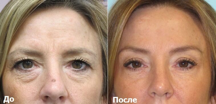 Пример подтяжки бровей фото до&nbsp;после