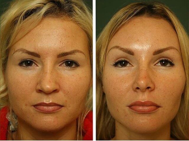 Фото до&nbsp;после фронтлифтинга