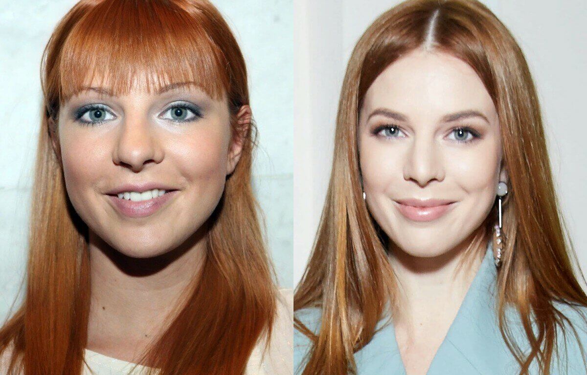 Наталья Подольская до и после пластики