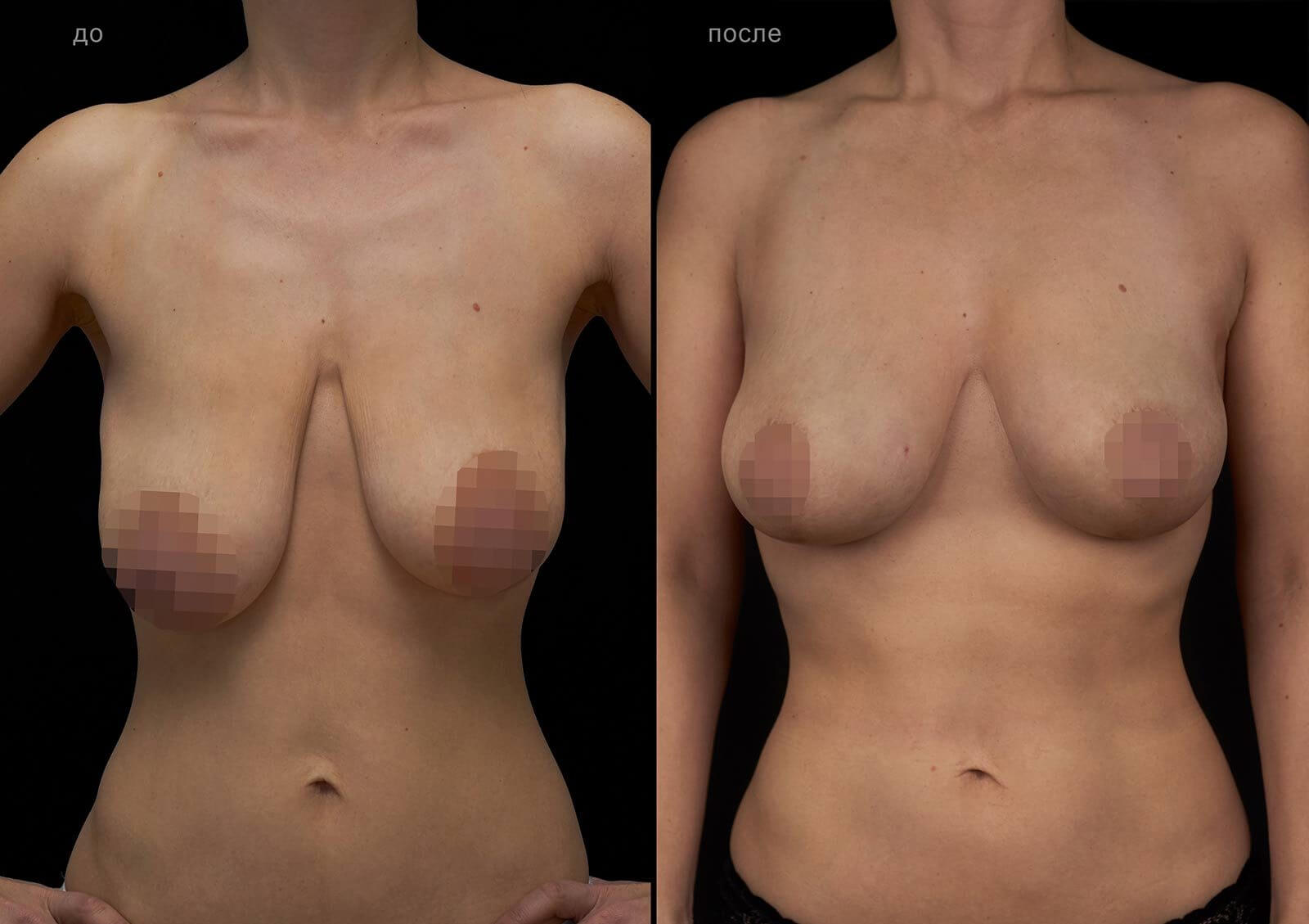 Мастопексия без установки имплантов – фото до и после