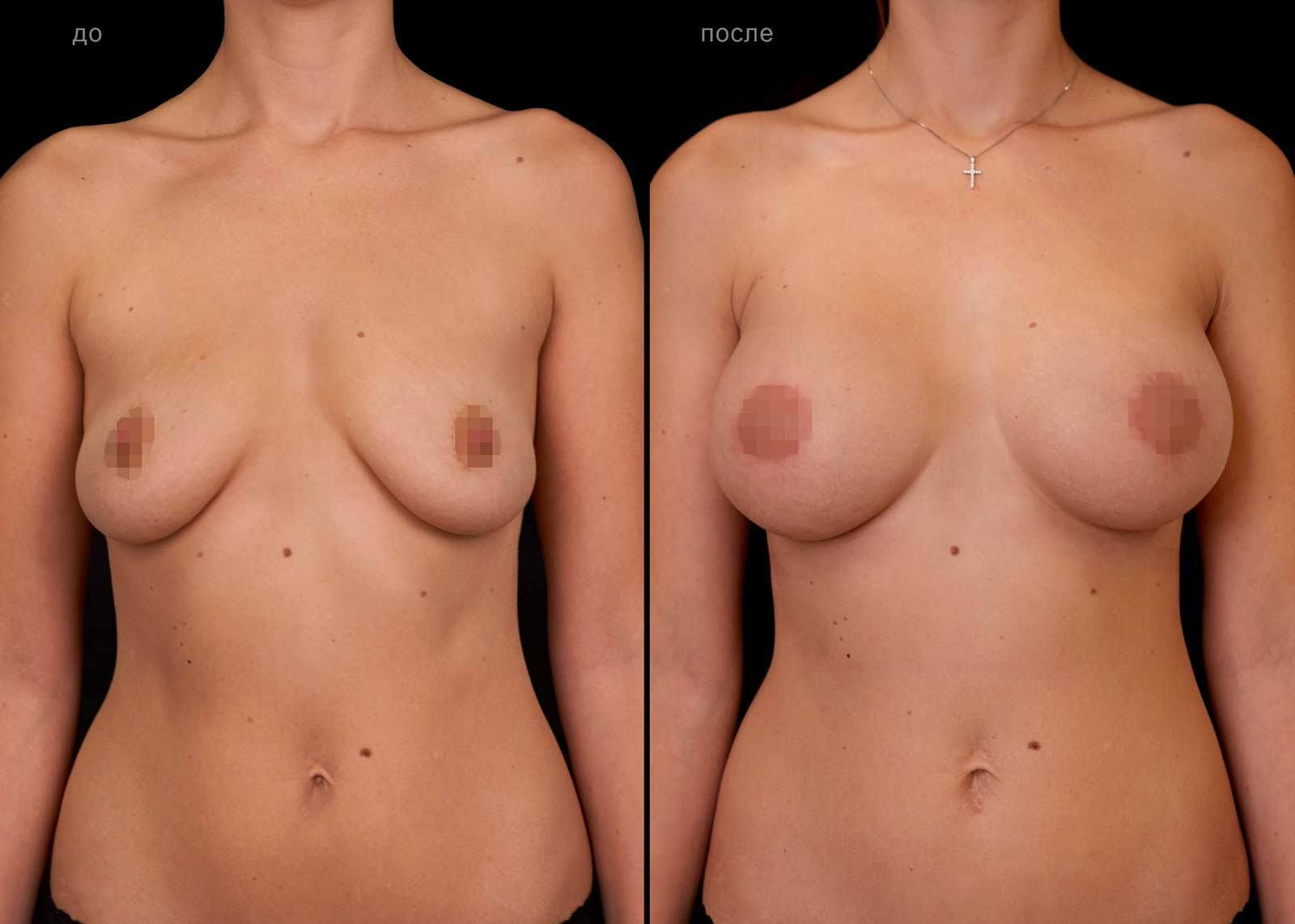 Подтяжка груди с установкой имплантов – фото до и после