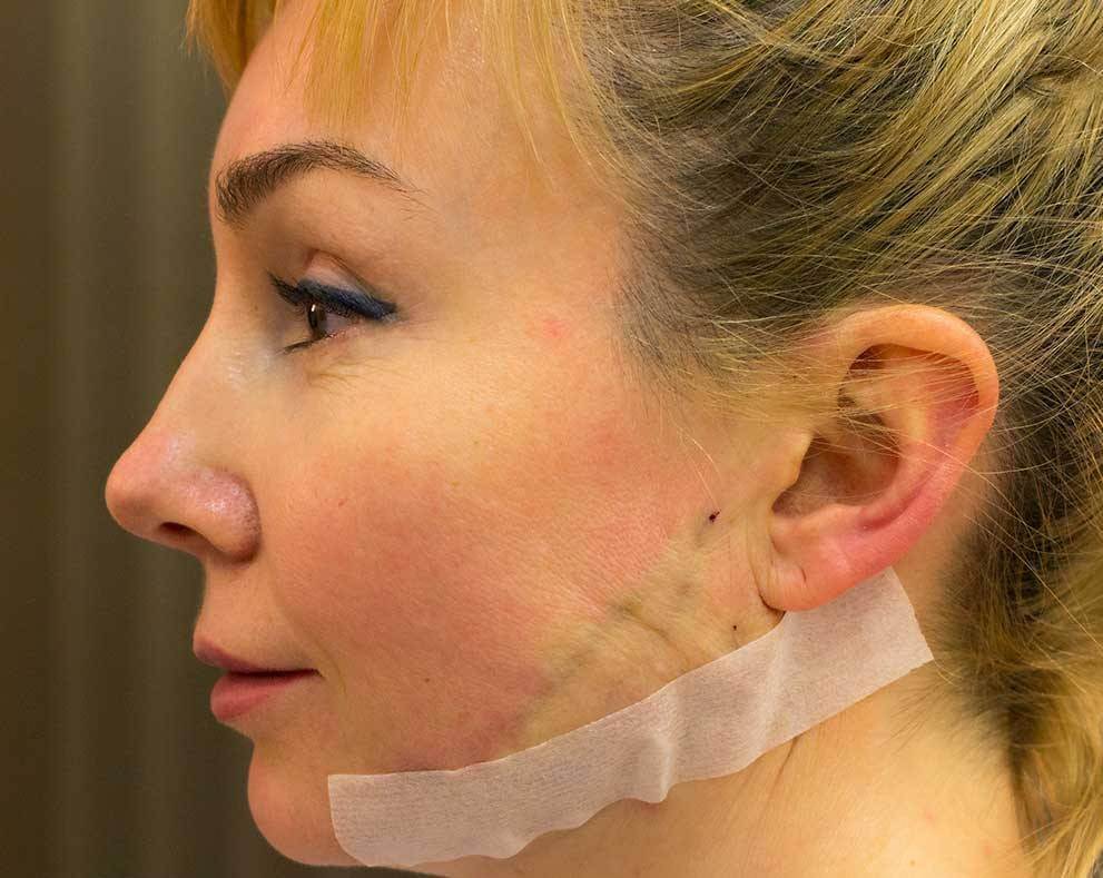 Шрамы после подтяжки нужно защищать от&nbsp;солнца