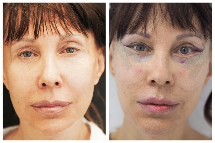 Не стоит ждать, что результат фейслифтинга проявится в&nbsp;первые дни и&nbsp;даже недели после операции