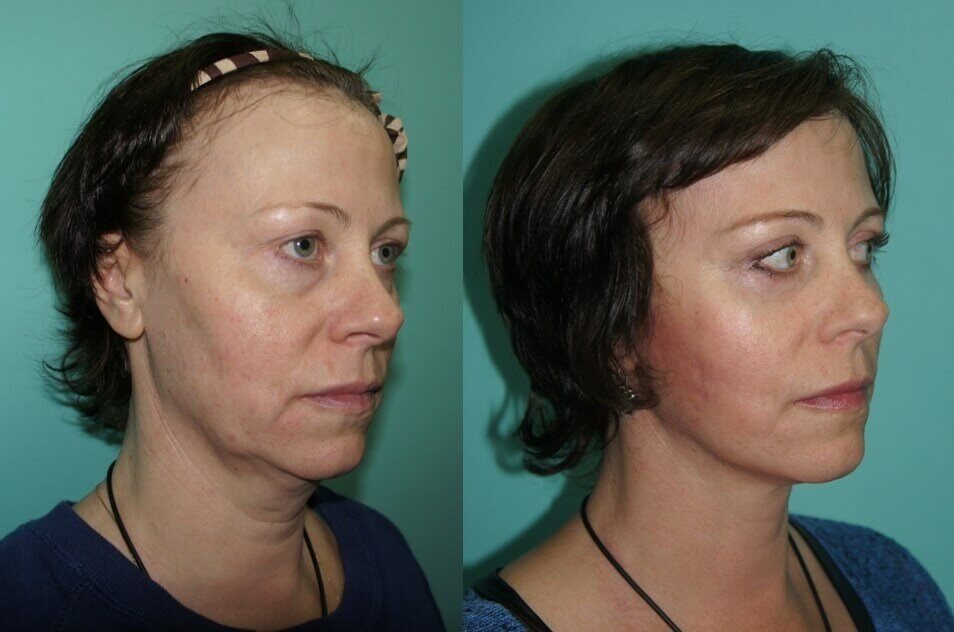 После фейслифтинга многие становятся визуально моложе на целое поколение