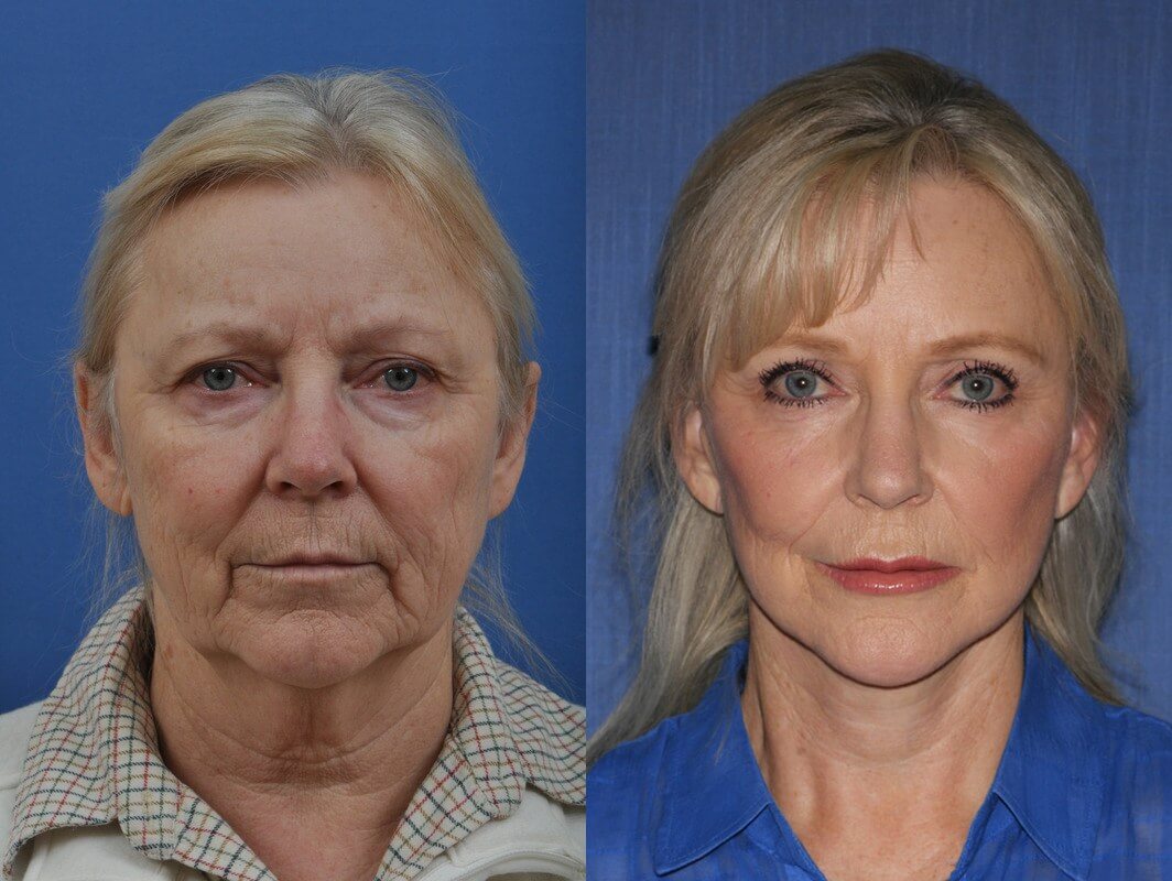 Если заботиться о себе, результаты подтяжки лица могут сохраниться на 20+ лет! 