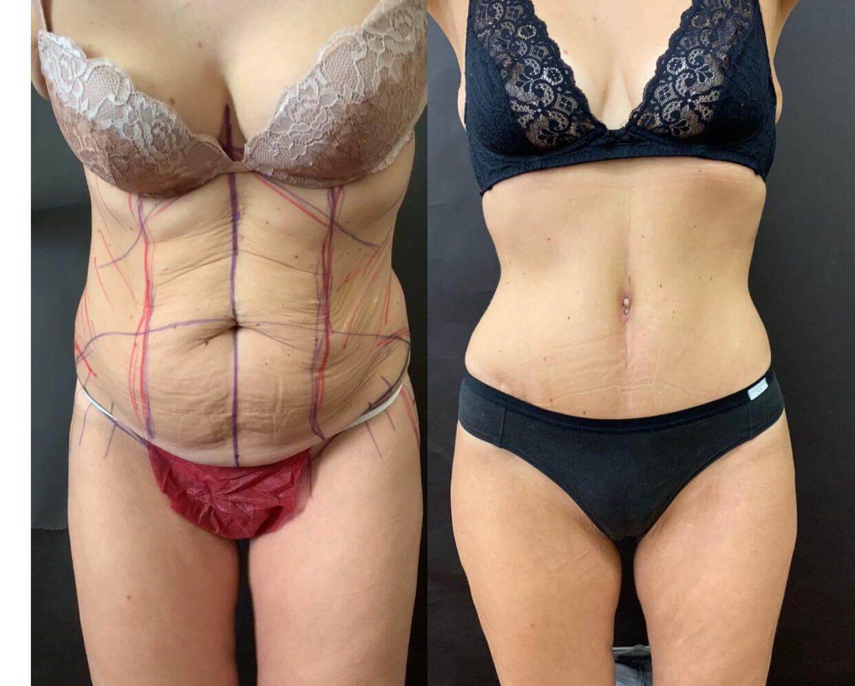 Правильно проведенная пластика после родов возвращает красоту. Не стоит торопиться с операцией, чтобы не испортить такие выдающиеся результаты.