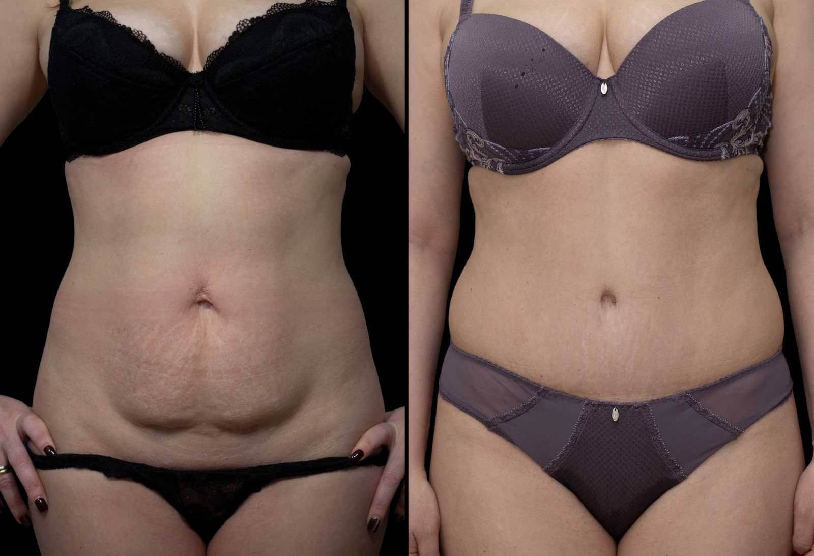 Делайте пластику, когда будете готовы к ней на 100%, и тогда результат приятно вас удивит.