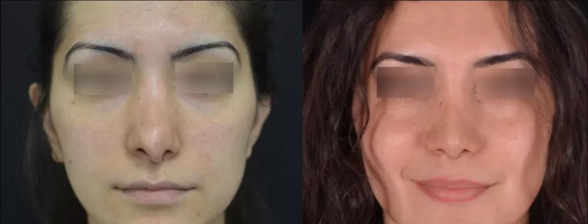 Повторная ринопластика: фото до&nbsp;и&nbsp;после