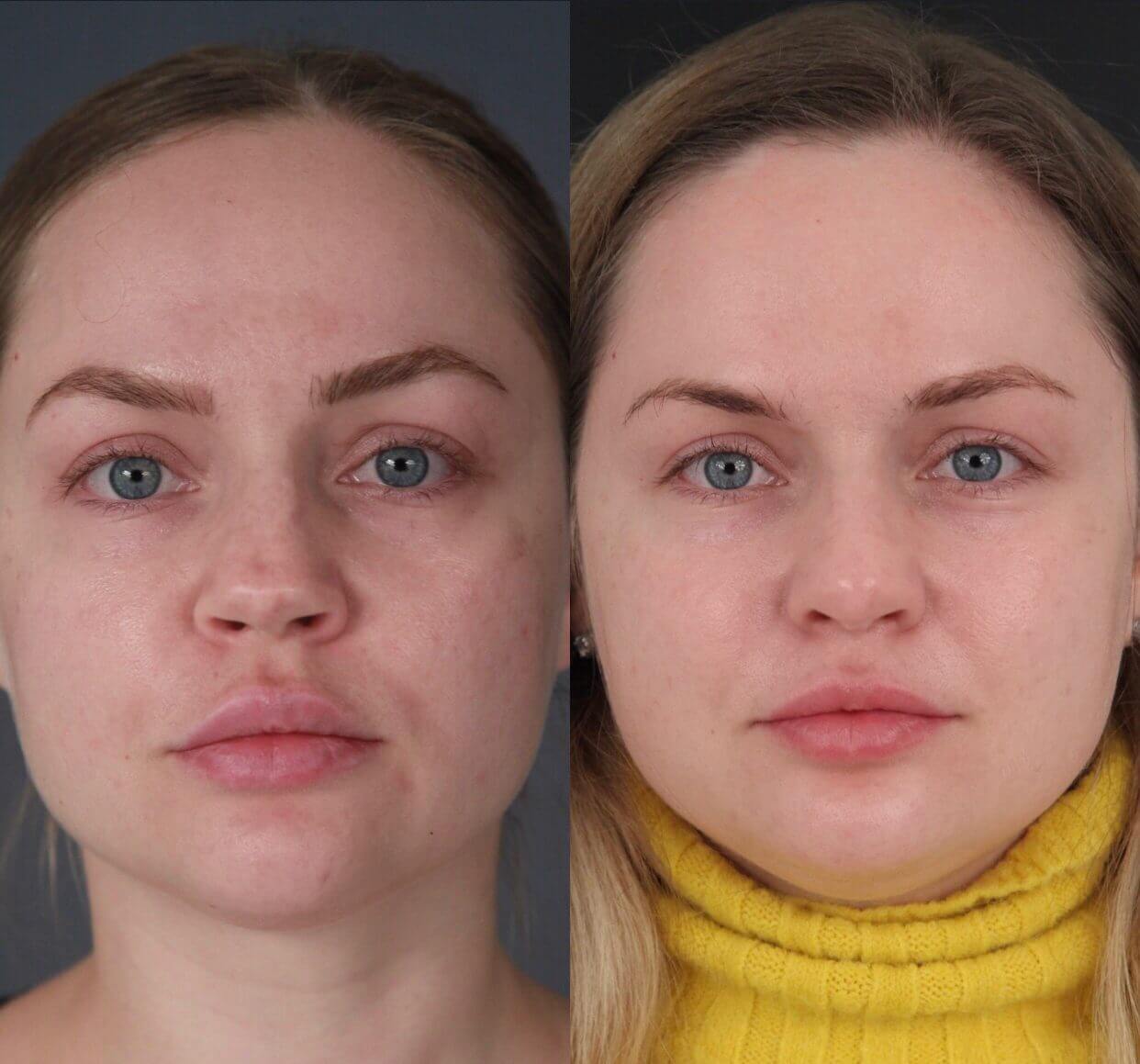 Повторная ринопластика из-за деформированной формы носа