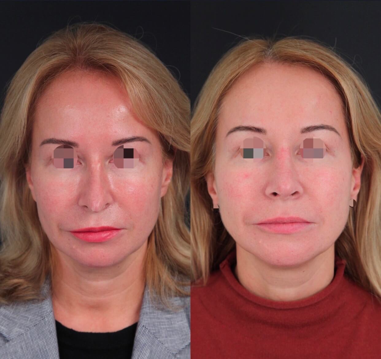 Вторичная ринопластика: фото до&nbsp;и&nbsp;после