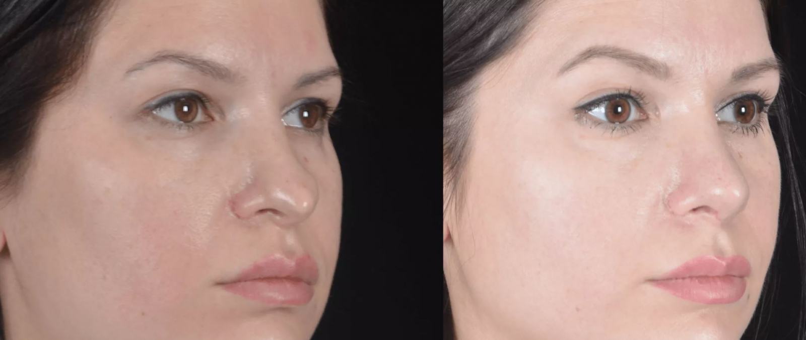 До и&nbsp;после повторной пластики кончика носа