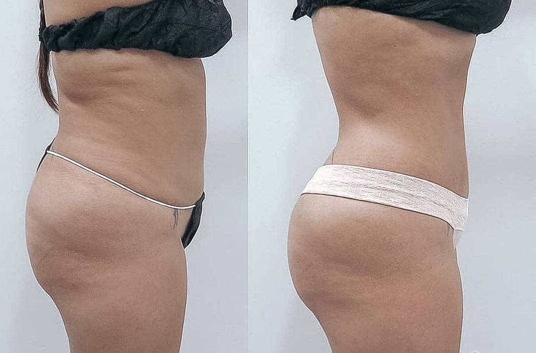 Грамотно выполненный липофилинг делает кожу гладкой и&nbsp;ровной