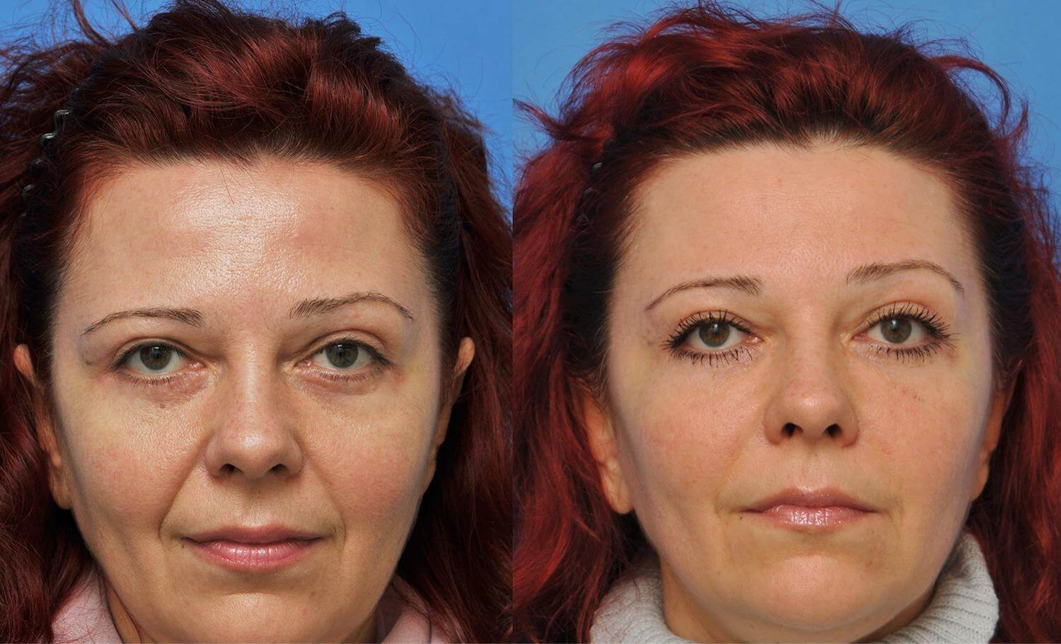 При липофилинге лица особенно важно равномерно вводить жировую ткань, чтобы не&nbsp;образовались шишки