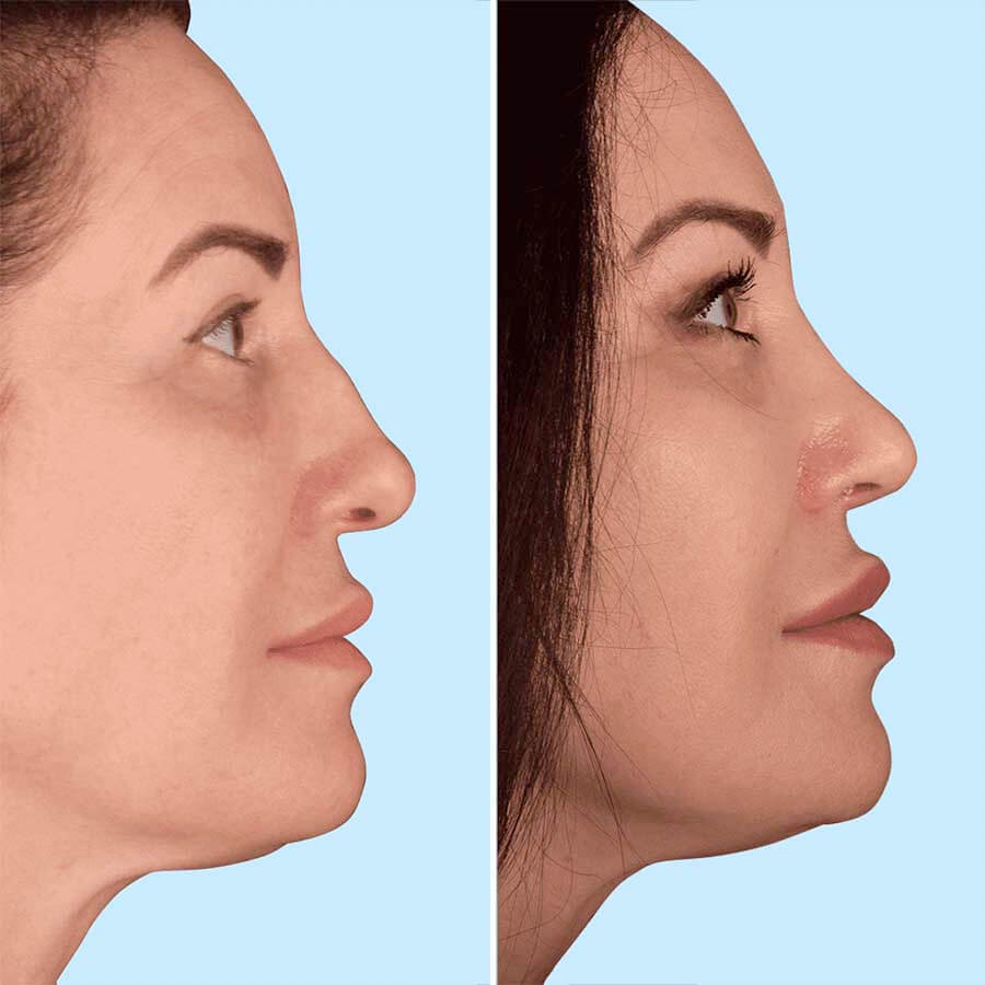 Фото до&nbsp;после ринопластики