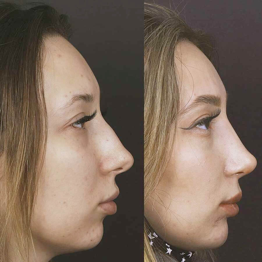 Фото до&nbsp;после ринопластики
