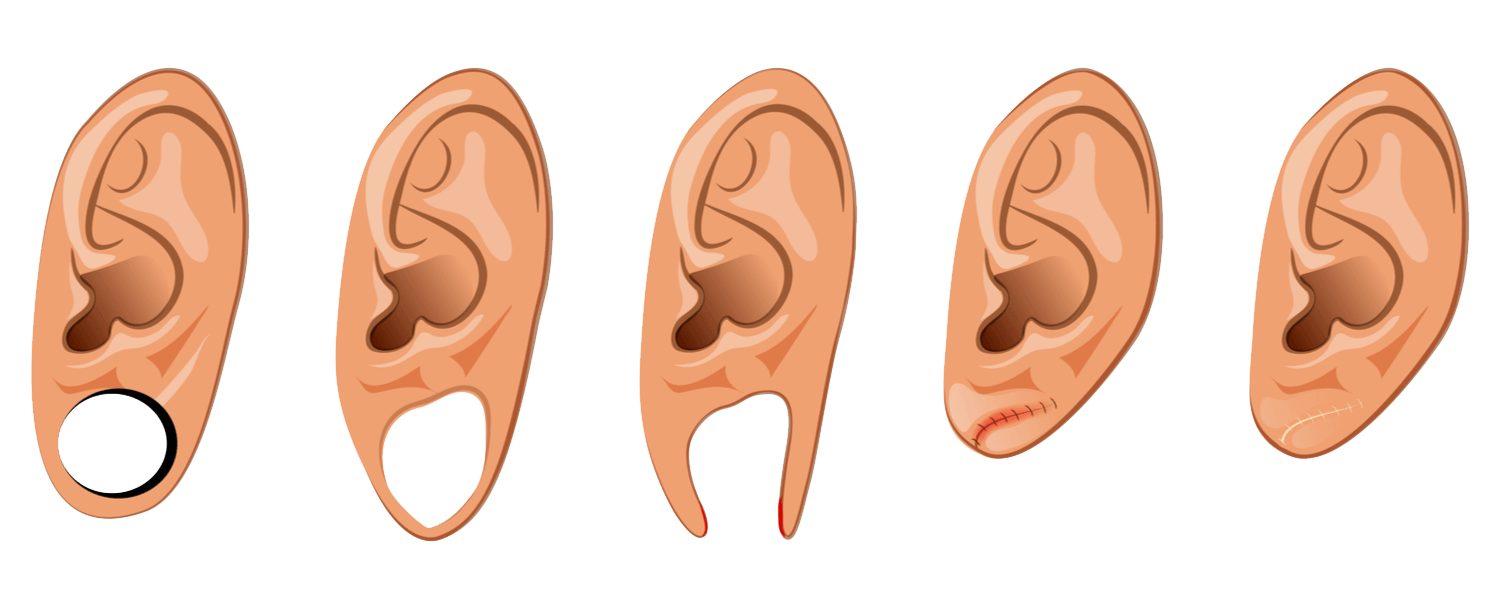 Так схематично выглядит пластика мочек ушей после тоннелей