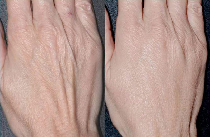 Фото до&nbsp;после липофилинга рук