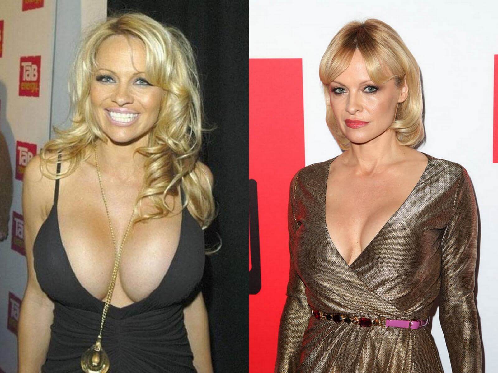 Памела Андерсон прославилась за&nbsp;счет огромной силиконовой груди, но&nbsp;все-таки поставила импланты меньшего размера 