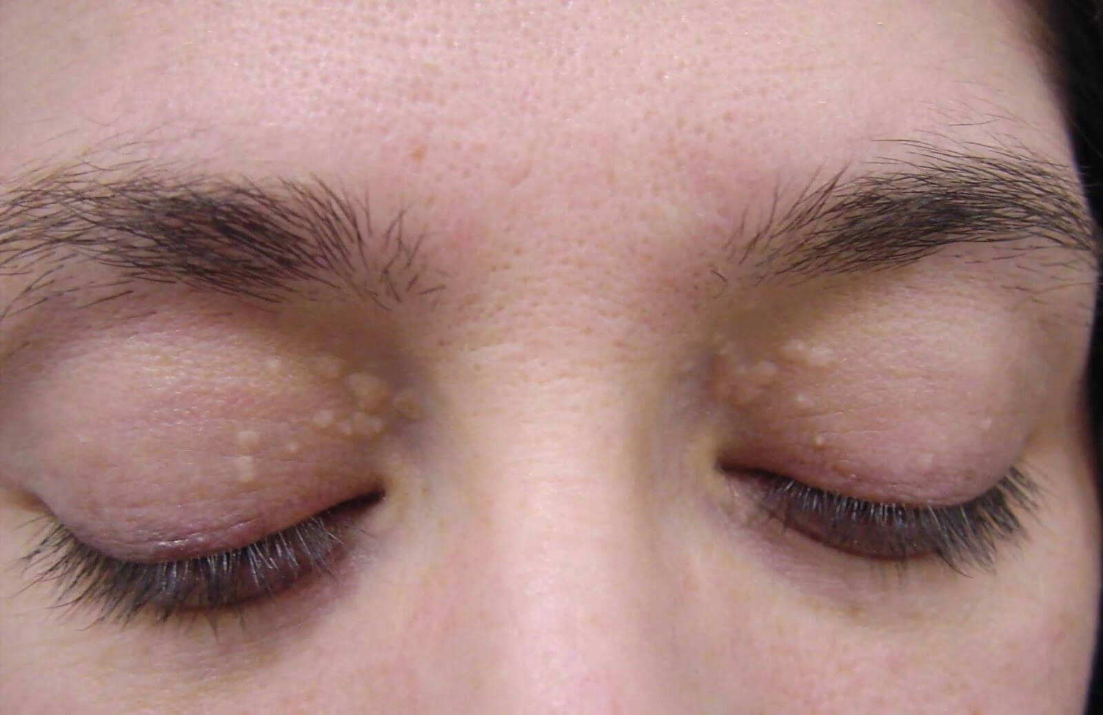 Жировые комочки на&nbsp;веках могут появиться и&nbsp;без липофилинга