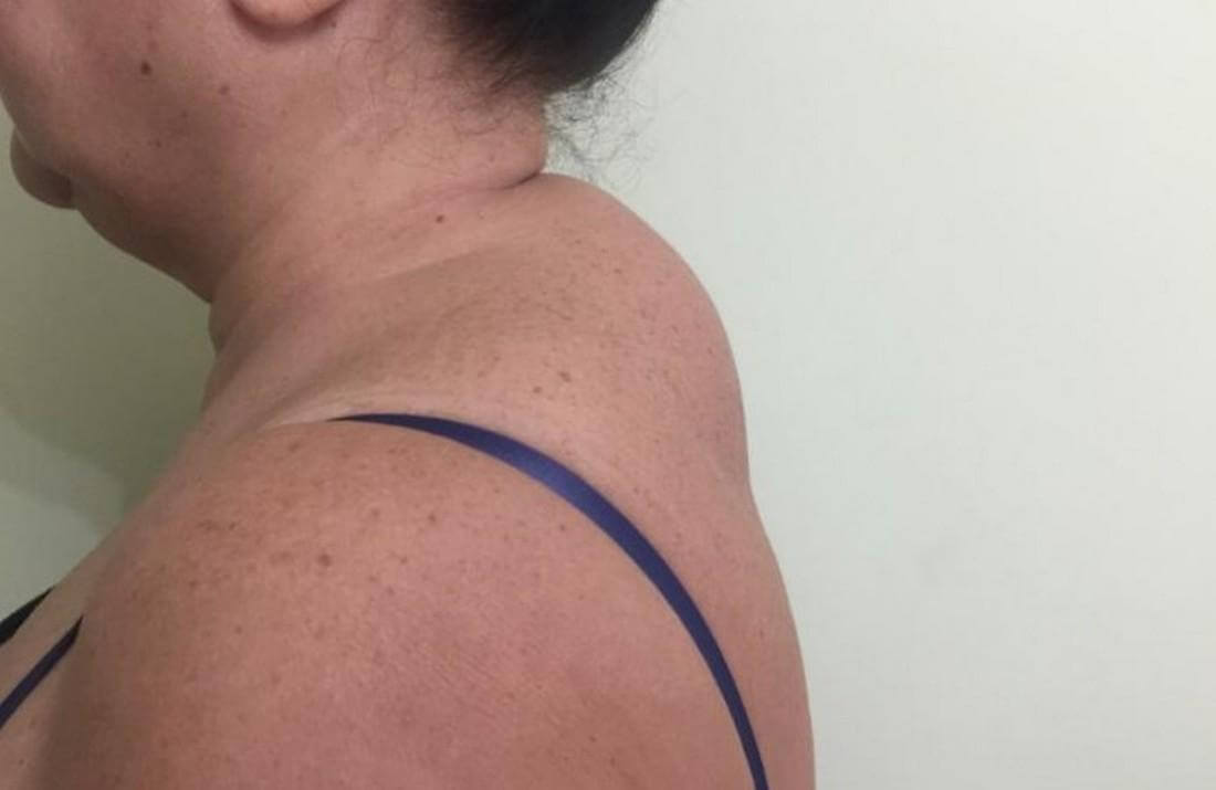 «Вдовий горб» – беда многих женщин старшего возраста