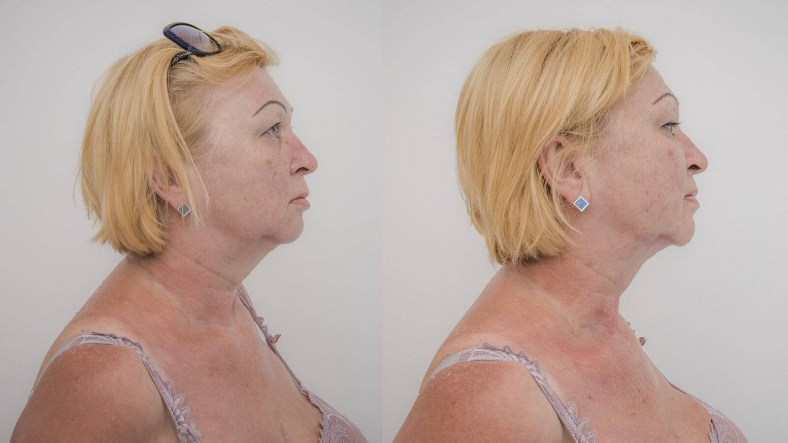 Липосакция холки дает быстрый и выраженный результат