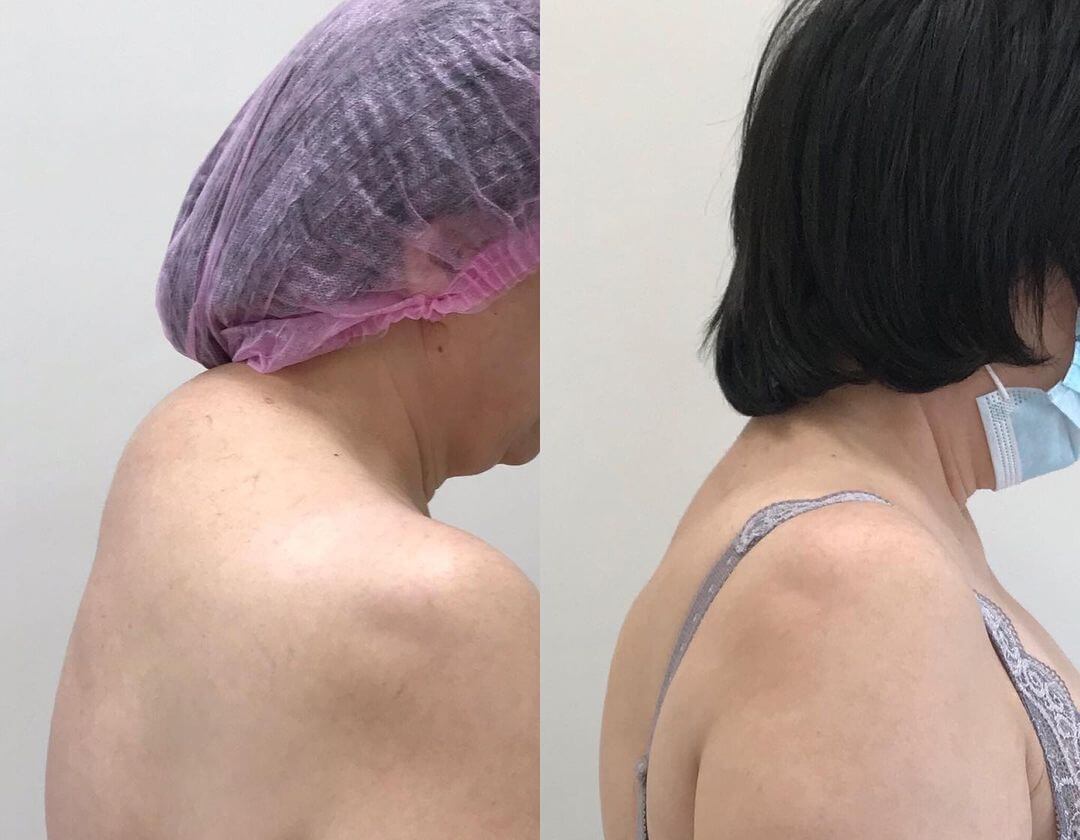 Липосакция «вдовьего горба» – до и после 