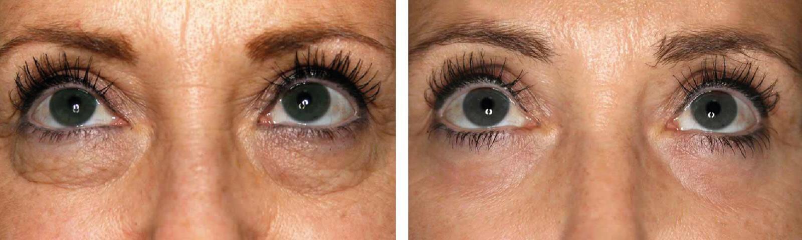 До и после удаления мешков под глазами