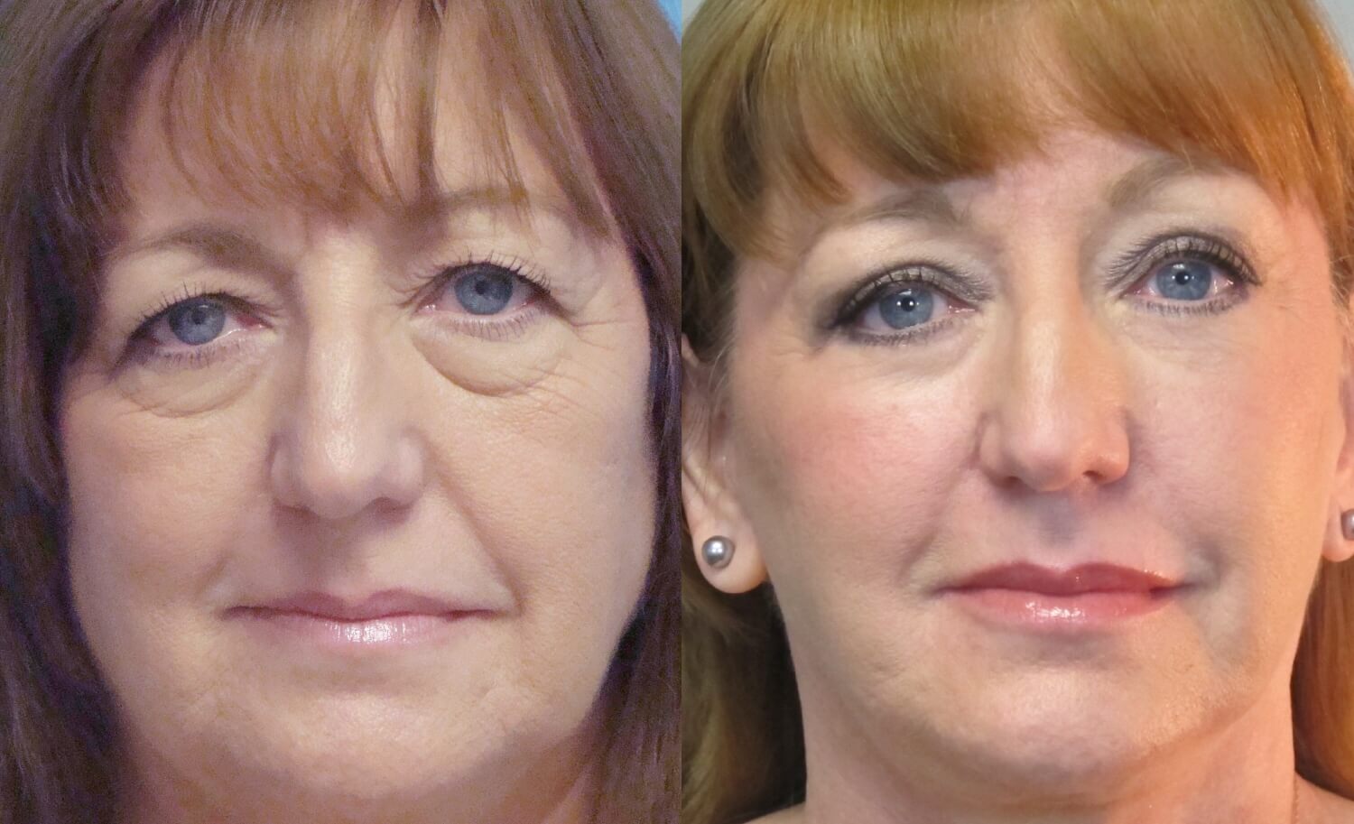 Круговая блефаропластика позволяет скинуть несколько лет