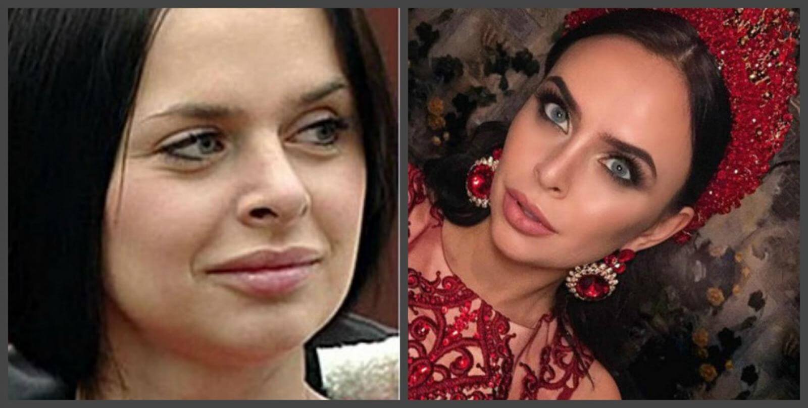 Звезда &laquo;Дома 2&raquo; активно пользуется возможностями пластической хирургии