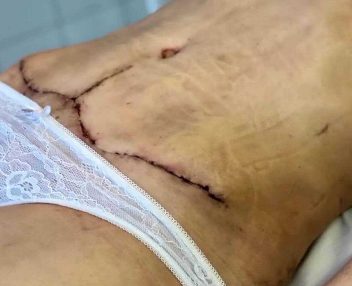 Вот так&nbsp;выглядят швы после абдоминопластики через 2 недели после операции. О&nbsp;спорте здесь не&nbsp;может быть и&nbsp;речи