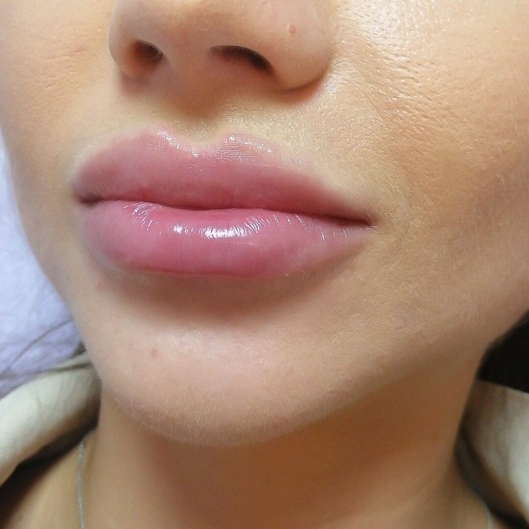 При увеличении губы теряют естественные складки, их контуры размываются