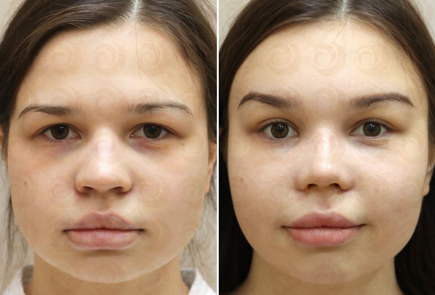 Пластика бровей &ndash; до&nbsp;и&nbsp;после