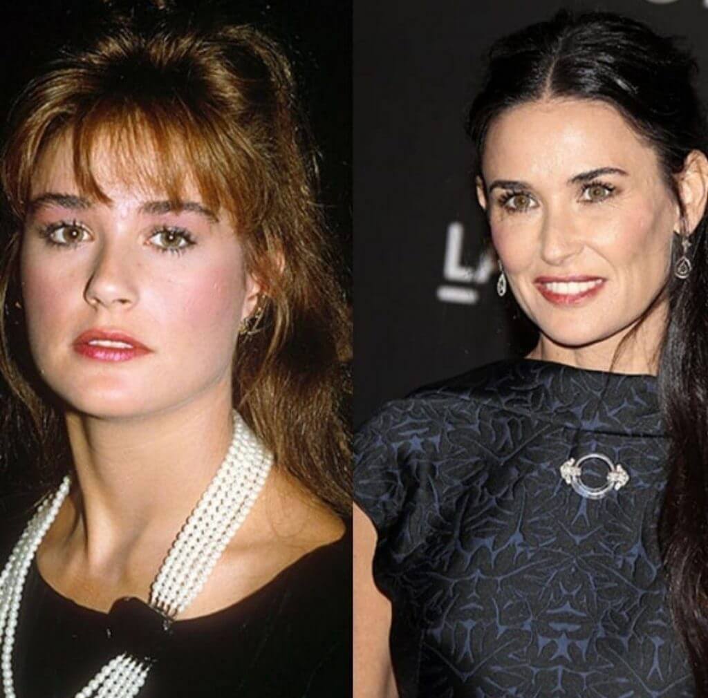 Пластика подбородка Деми Мур – до и после