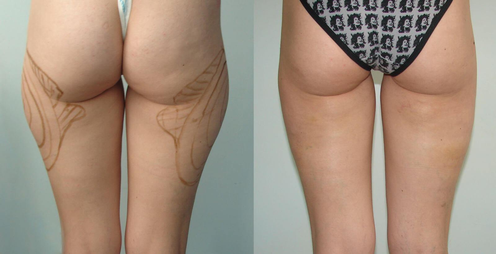 Фото липосакции бедер и&nbsp;ягодиц: до&nbsp;и&nbsp;после операции