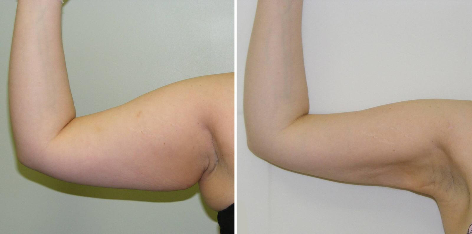 Фото липосакции рук: до&nbsp;и&nbsp;после операции