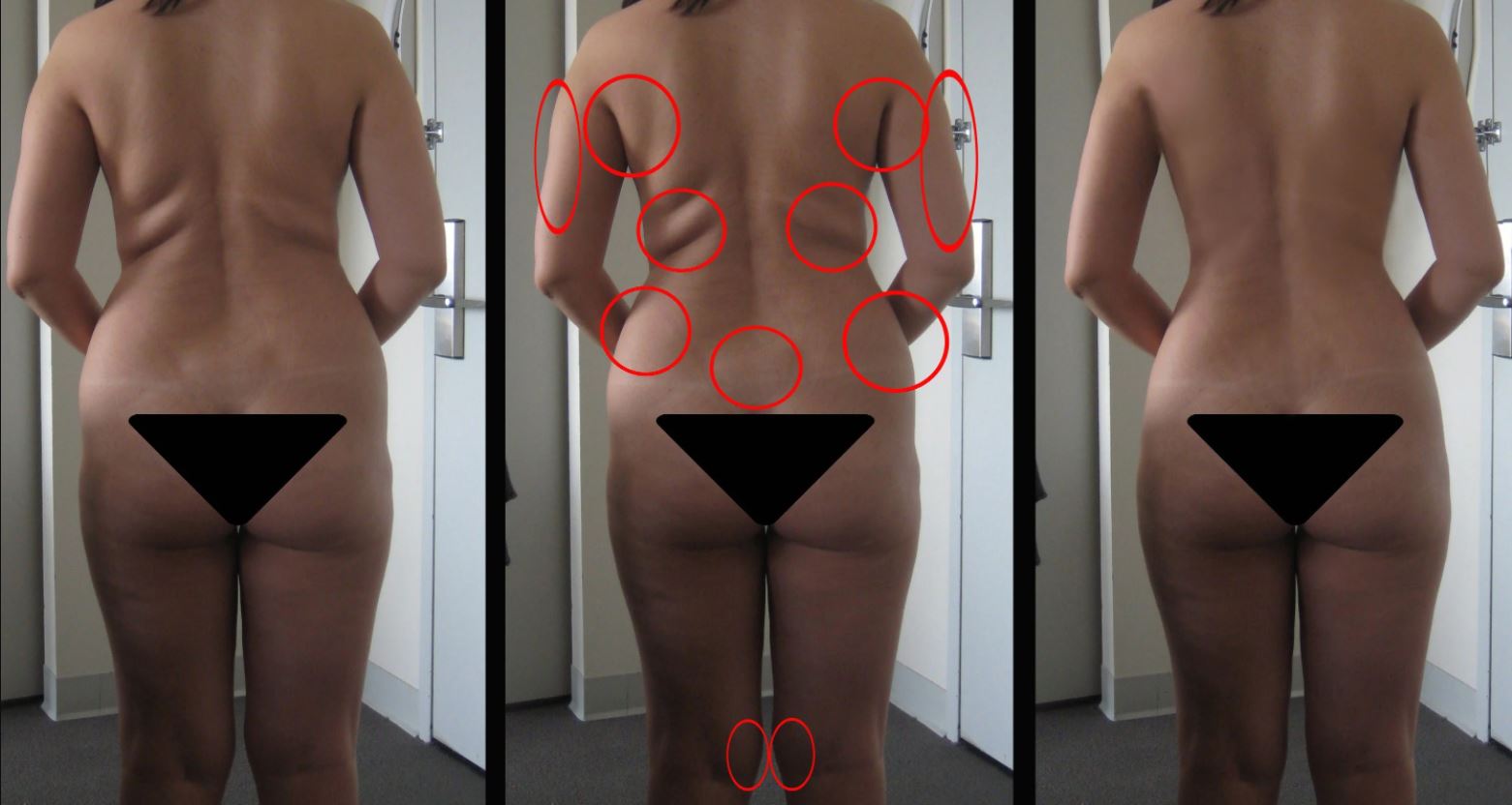 Комплексная липосакция тела: удаление жира сразу с&nbsp;нескольких проблемных областей