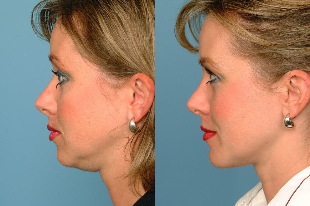 Липосакция и подтяжка кожи дают отличный результат