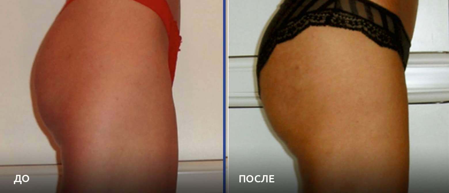 С помощью липофилинга можно скорректировать форму и&nbsp;размер ягодиц, не&nbsp;нарушая их естественного внешнего вида