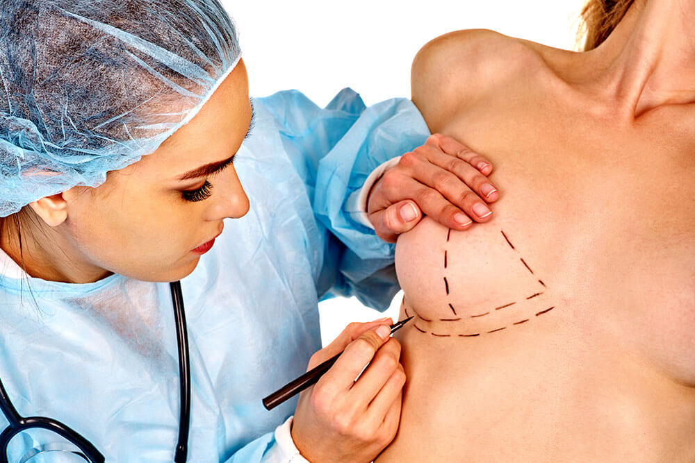 Расположение и&nbsp;размеры шрамов после маммопластики всегда индивидуальны