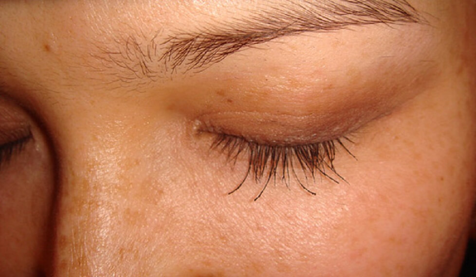 Пересаженные в&nbsp;зону роста ресниц волосы с&nbsp;головы нужно стричь, чтобы они не&nbsp;выглядели пугающе длинными