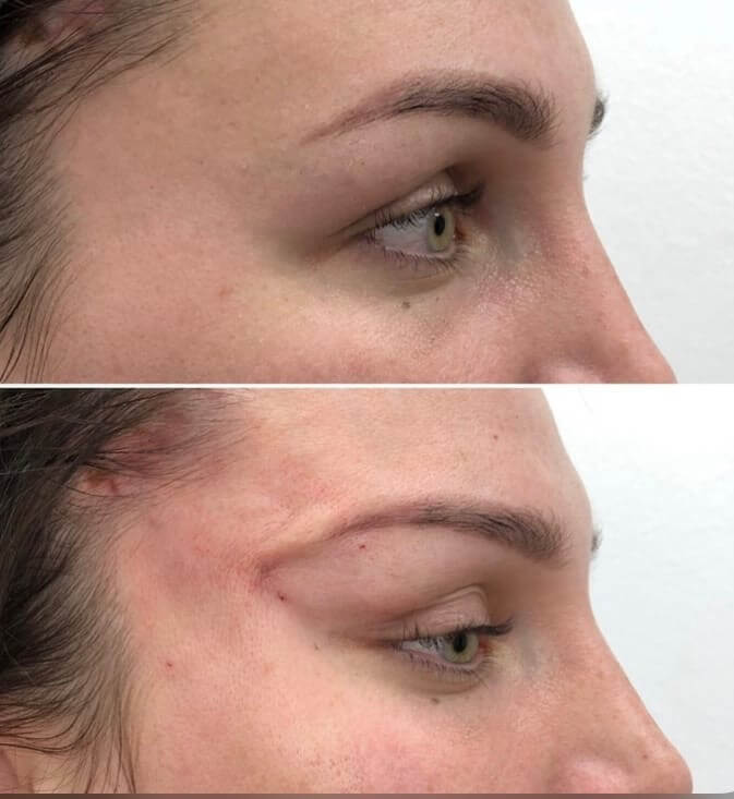 Рубцы после получения «лисьих глазок» с помощью нитевого лифтинга 